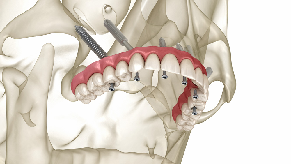 Cirurgia d'imaplant zigomàtic