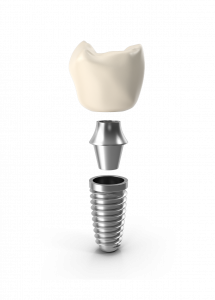 Implant dental a Lleida
