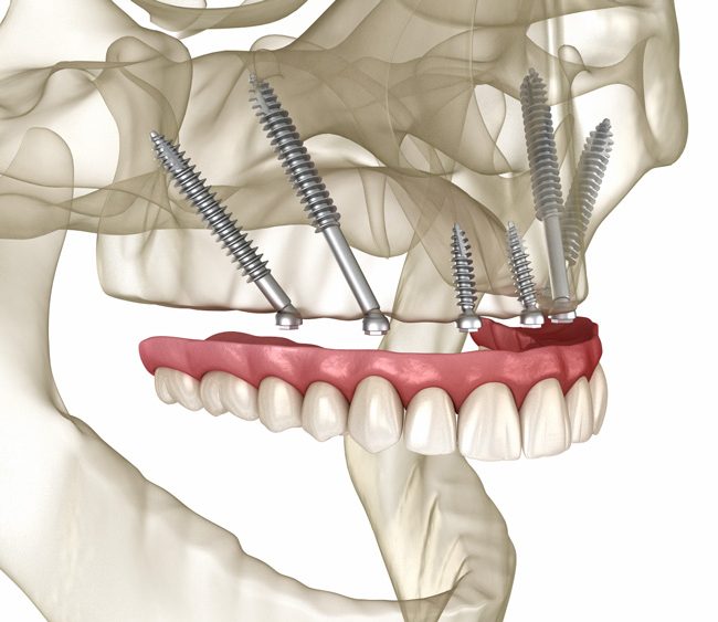 Implants zigomàtics per a pèrdua d'os