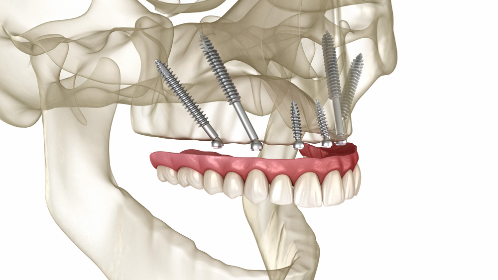 Implants zigomàtics per a pèrdua d'os