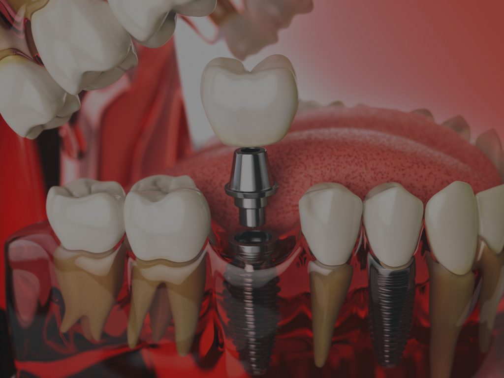 riscos dels implants dentals