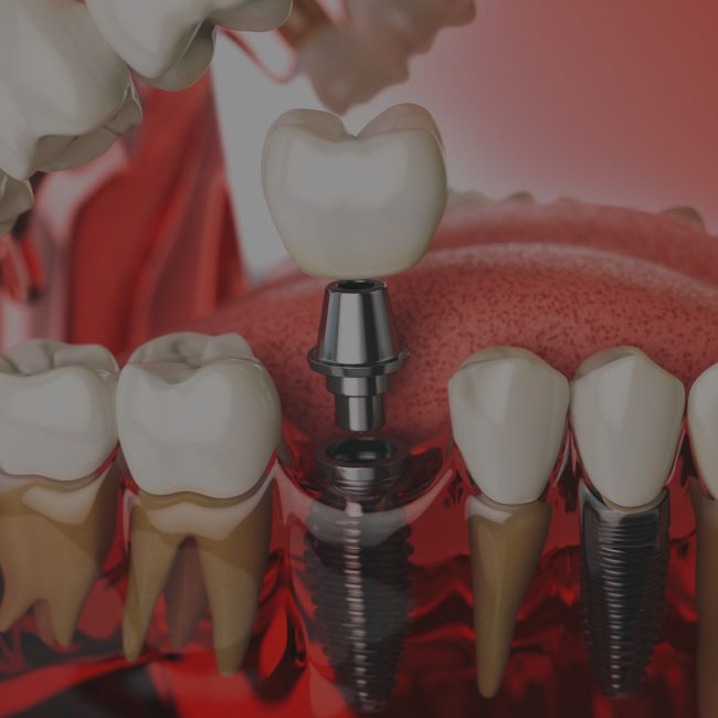 riscos dels implants dentals