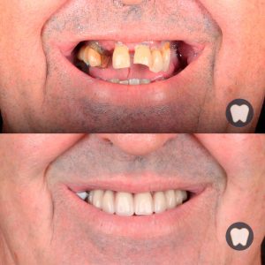 Implants dentals a Lleida