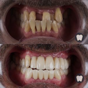 Caso real estética dental