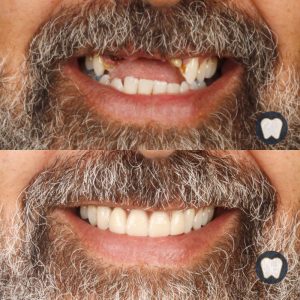 Implants dentals a Lleida