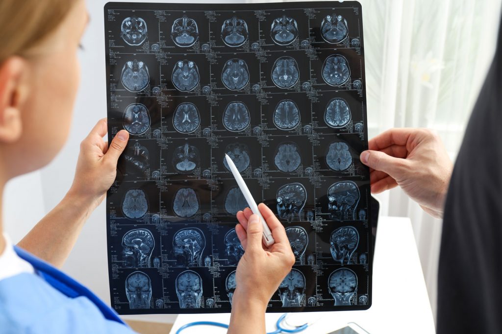 causa de l'Alzheimer