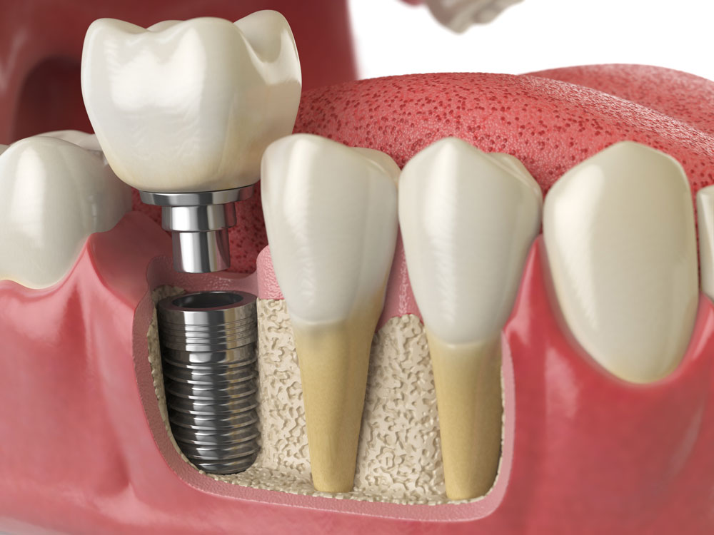osteointegració implant