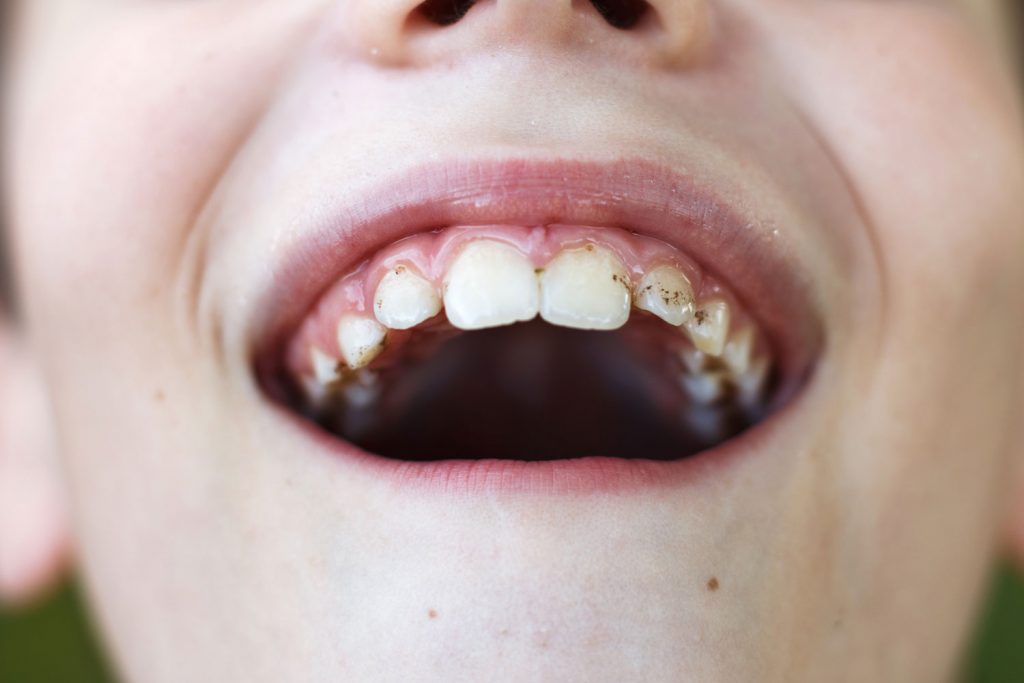 taques negres a les dents