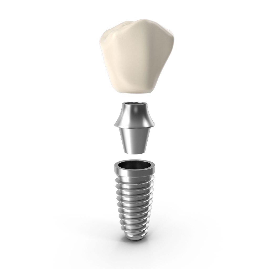 implant dental