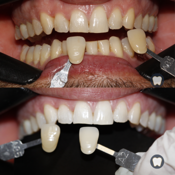 Caso real estética dental