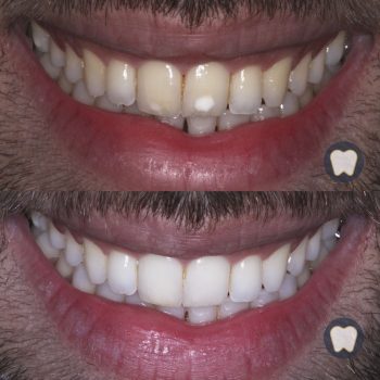 Caso real estética dental