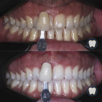 Caso real estética dental