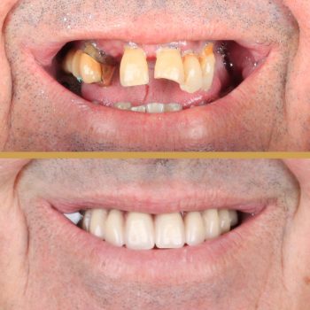 caso-implantes-dentales