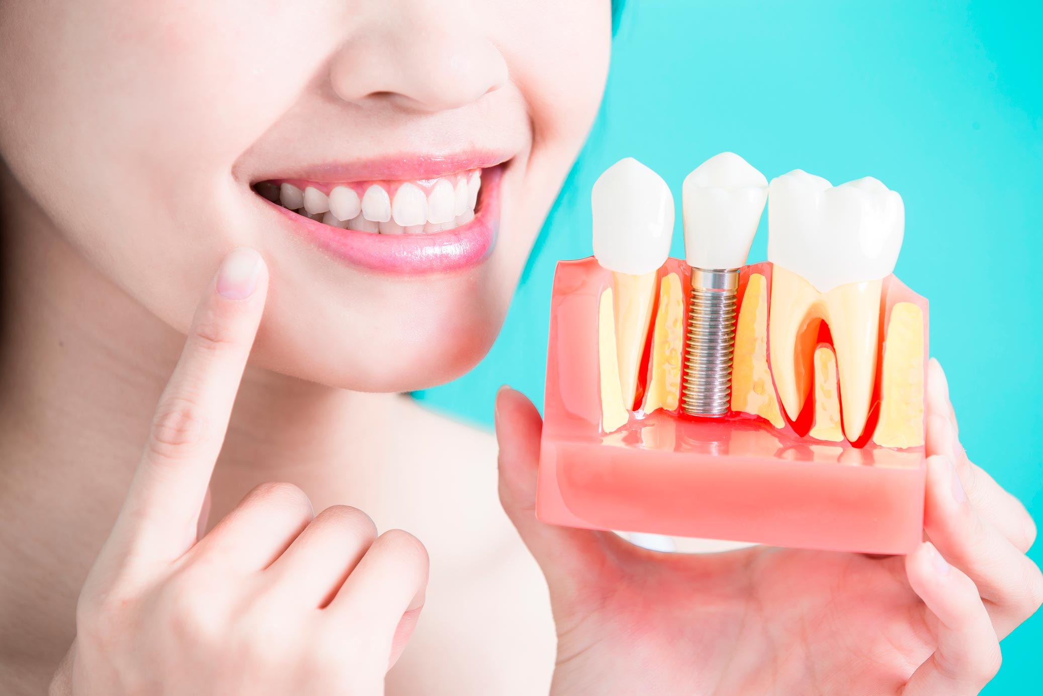 implantes dentales en un día